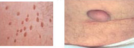 Skin tag and polyp removal