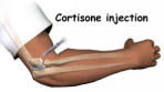 Cortisone Injections