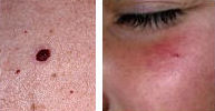 Removal of Cherry Spots (Campbell de Morgan spots) and Spider Naevi (dilated blood vessels)