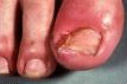 Minor surgery procedures for ingrowing toe nails
