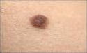 Mole removal